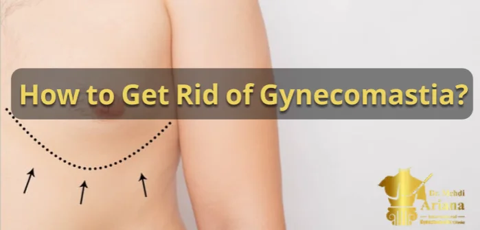 get rid of gynecomastia